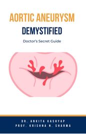 Aortic Aneurysm Demystified: Doctor s Secret Guide
