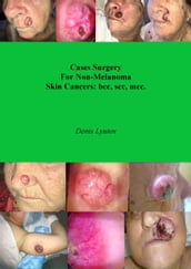 Cases Surgery For Non-Melanoma Skin Cancers: bcc, scc, mcc.