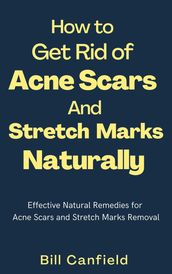 How to Get Rid of Acne Scars and Stretch Marks Naturally