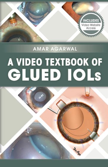 A Video Textbook of Glued IOLs - Amar Agarwal