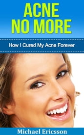 Acne No More: How I Cured My Acne Forever