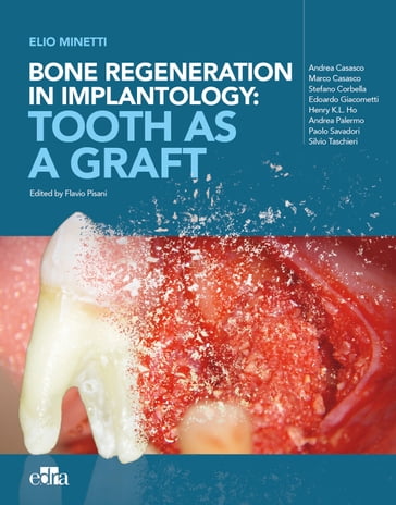 Bone regeneration in implantology: tooth as a graft - Elio Minetti