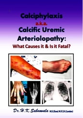 Calciphylaxis a.k.a. Calcific Uremic Arteriolopathy: What Causes it & Is it Fatal?