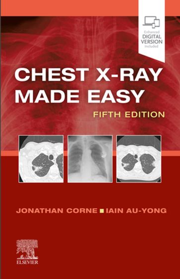 Chest X-Ray Made Easy E-Book - MA  PhD  MB BS  FRCP Jonathan Corne - MA  BMBCh  MRCS  FRCR Iain Au-Yong