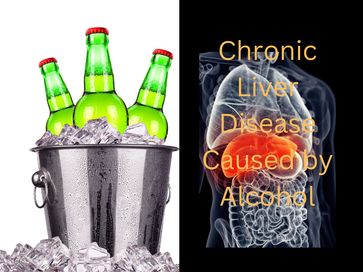 Chronic Liver Disease Caused by Alcohol - Akpabio Nsisong