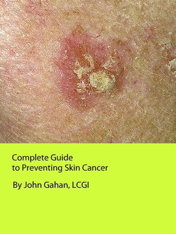 Complete Guide to Preventing Skin Cancer - LCGI John Gahan
