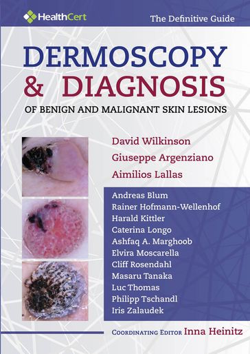 Dermoscopy and Diagnosis of Benign and Malignant Skin Lesions - Aimilios Lallas - Giuseppe Argenziano