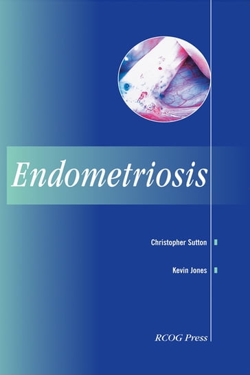 Endometriosis - Sutton Christopher - Kevin Jones