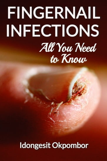 Fingernail Infections - Idongesit Okpombor