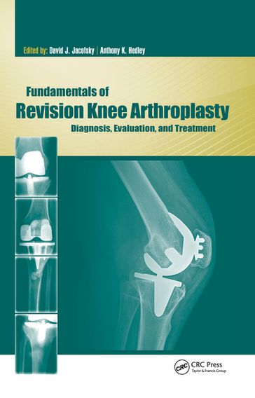 Fundamentals of Revision Knee Arthroplasty - David Jacofsky - Anthony Hedley