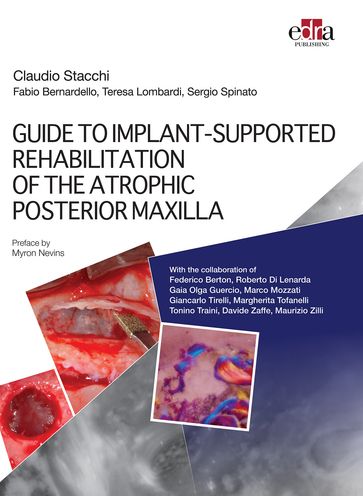 GUIDE TO IMPLANT-SUPPORTED REHABILITATION OF THE ATROPHIC POSTERIOR MAXILLA - Claudio Stacchi - Fabio Bernardello - Teresa Lombardi - Sergio Spinato