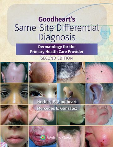 Goodheart's Same-Site Differential Diagnosis - Herbert Goodheart