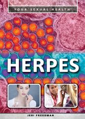 Herpes