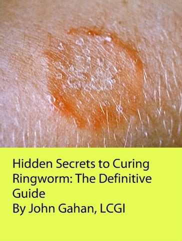 Hidden Secrets to Curing Ringworm: The Definitive Guide - LCGI John Gahan