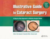 Illustrative Guide to Cataract Surgery