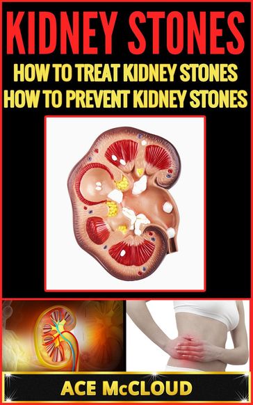 Kidney Stones: How To Treat Kidney Stones: How To Prevent Kidney Stones - Ace McCloud