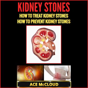 Kidney Stones: How To Treat Kidney Stones: How To Prevent Kidney Stones - Ace McCloud