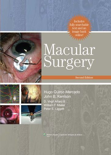 Macular Surgery - D. Virgil Alfaro - Hugo Quiroz-Mercado - John B. Kerrison - Peter E. Liggett - William F. Mieler