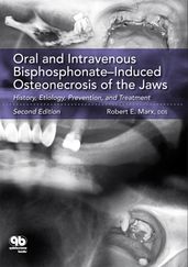 Oral and Intravenous BisphosphonateInduced Osteonecrosis of the Jaws