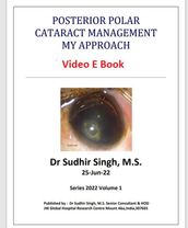 Posterior Polar Cataract Management: My Approach