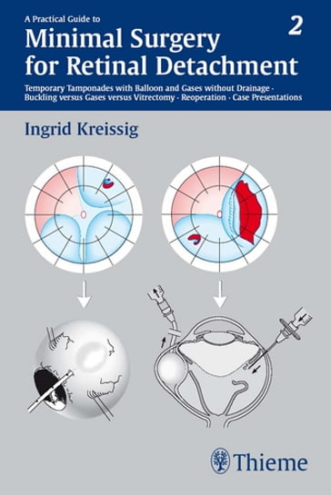 A Practical Guide to Minimal Surgery for Retinal Detachment, Vol. 2 - Ingrid Kreissig