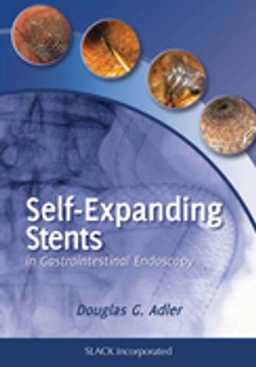 Self-Expanding Stents in Gastroenterology - Douglas Adler