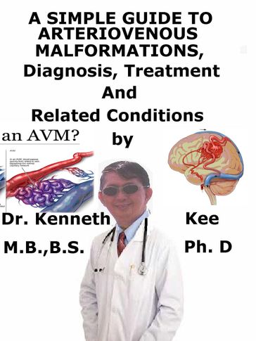 A Simple Guide to Arteriovenous Malformations, Diagnosis, Treatment and Related Conditions - Kenneth Kee
