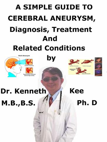 A Simple Guide to Cerebral Aneurysm, Diagnosis, Treatment and Related Conditions - Kenneth Kee