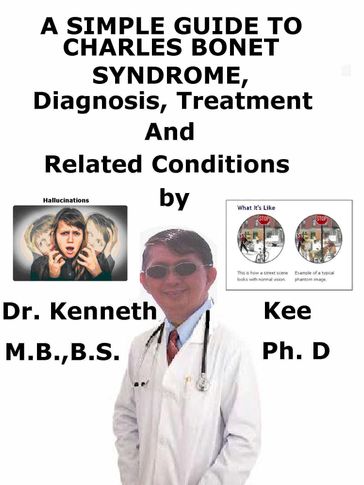 A Simple Guide to Charles Bonnet Syndrome, Diagnosis, Treatment and Related Conditions - Kenneth Kee