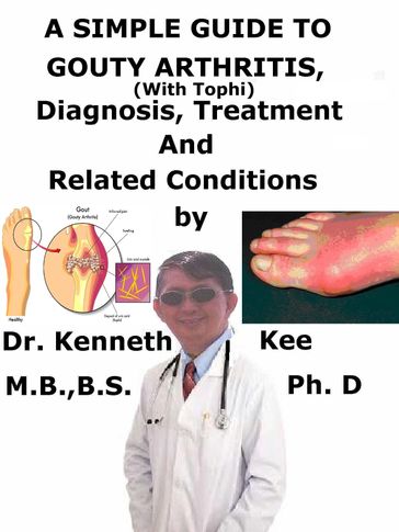 A Simple Guide to Gouty Arthritis (With Tophi), Diagnosis, Treatment and Related Conditions - Kenneth Kee