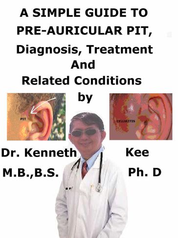 A Simple Guide to Pre-auricular Pit, Diagnosis, Treatment and Related Conditions - Kenneth Kee