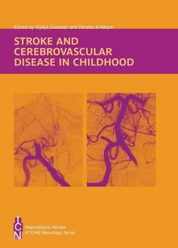 Stroke and Cerebrovascular Disease in Childhood - Fenella Kirkham - Vijeya Ganesan