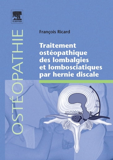 Traitement ostéopathique des lombalgies et lombosciatiques par hernie discale - François Ricard