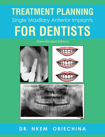 Treatment Planning Single Maxillary Anterior Implants for Dentists - Dr. Nkem Obiechina