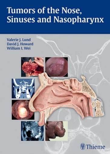 Tumors of the Nose, Sinuses and Nasopharynx - Valerie J. Lund - David Howard - William I. Wei