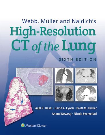 Webb, Müller and Naidich's High-Resolution CT of the Lung - Anand Devaraj - Brett M Elicker - David Lynch - Nicola Sverzellati - Sujal Desai