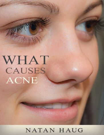 What Causes Acne - Natan Haug